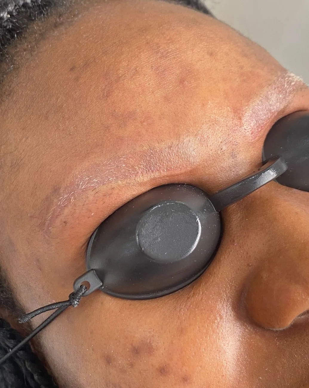 How Long Does It Take to Heal After Eyebrow Tattoo Removal?