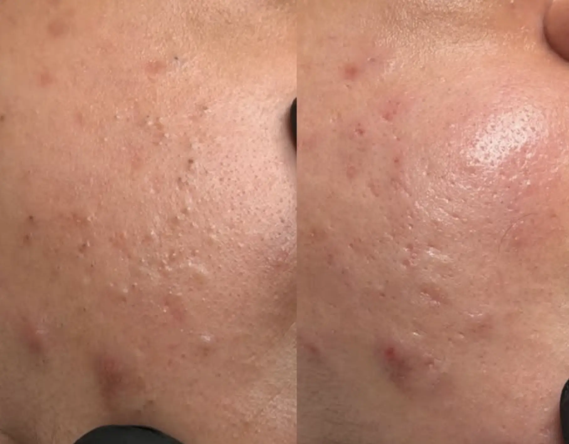 Vitrier Moissy Cramayel | What Helps Redness And Rosacea-Like Flushing (And What Should I Avoid)? can you workout after dermaplaning