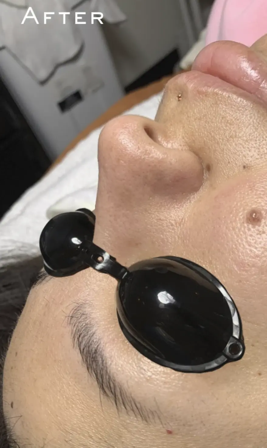 Vitrier Moissy Cramayel | What Helps Redness And Rosacea-Like Flushing (And What Should I Avoid)? dermaplaning course cost