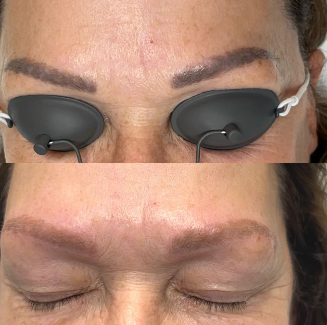 Vitrier Moissy Cramayel | How Long Does It Take to Heal After Eyebrow Tattoo Removal? tattoo removal